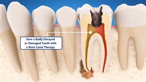 Save a Badly Decayed or Damaged Tooth with a Root Canal Therapy - Smile Perfectors