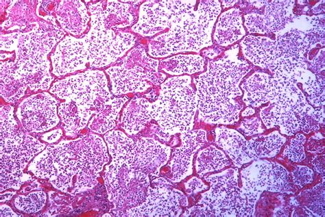 Pneumonia | NURSING LECTURE