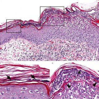 Canine epidermal collarettes-clinical lesions. (a,c,d) Annular to... | Download Scientific Diagram