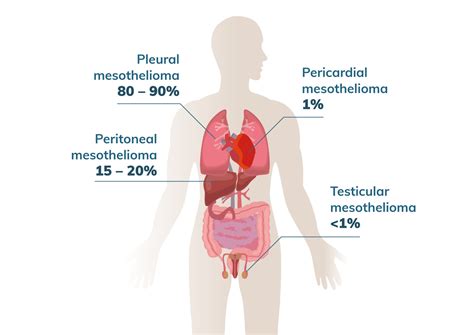 4 Types of Mesothelioma | Cell Location, Cell Type and Treatment