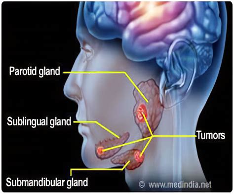 Salivary Glands Cancer