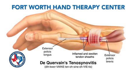 De Quervain’s Tenosynovitis