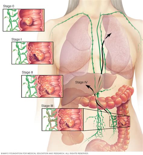 Illustration showing colon cancer stages