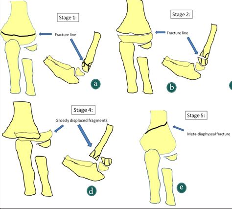 Pediatric Fracture Classification | My XXX Hot Girl