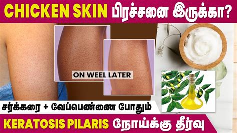 Affected By Keratosis Pilaris Disease? | Home Remedies To Cure Chicken Skin | IBC Mangai - YouTube