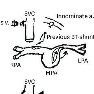 Sequential operation record. (A) Right modified BT shunt with a 3.5-mm... | Download Scientific ...