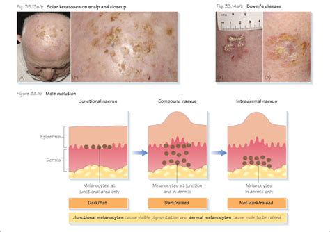 Benign skin lesions | Plastic Surgery Key