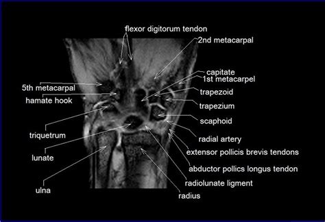 MRI wrist coronal anatomy | wrist tendon and ligaments anatomy | cross ...