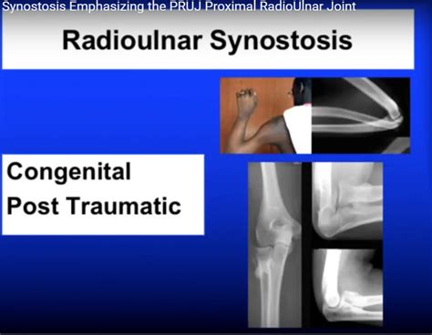 Radioulnar Synostosis — OrthopaedicPrinciples.com