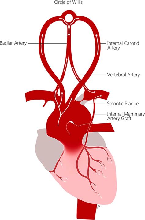 Left Subclavian Steal Syndrome - Quotes Viral