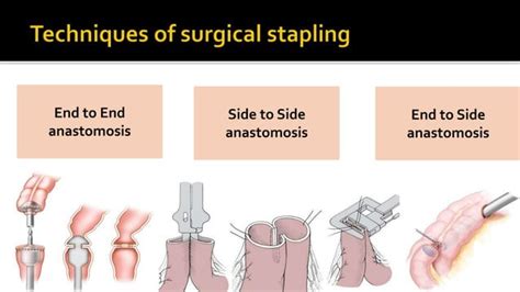 Bowel anastomosis