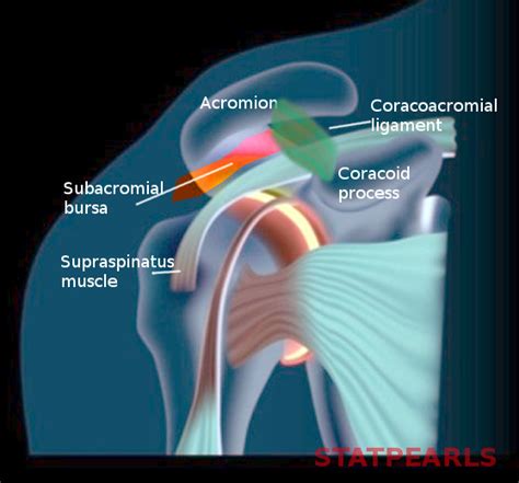 Subacromial Bursitis - StatPearls - NCBI Bookshelf