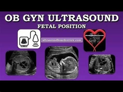 How To Determine Fetal Presentation and Fetal Situs Ultrasound - YouTube