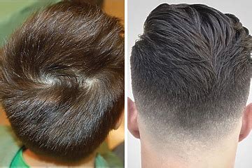 Double Crown Vs Balding: Differences, Symptoms, Treatments