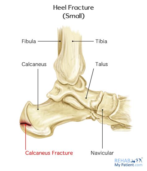 Heel Fracture | Rehab My Patient