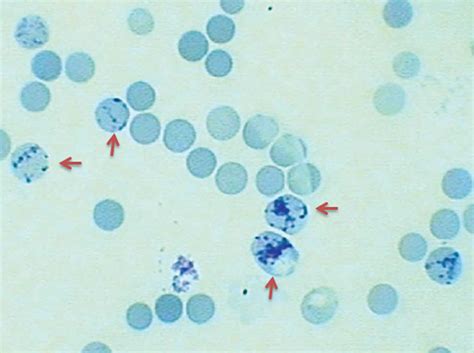 Anemia Reticulocyte