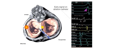 SVT EP Study & Ablation - One Heart Cardiology