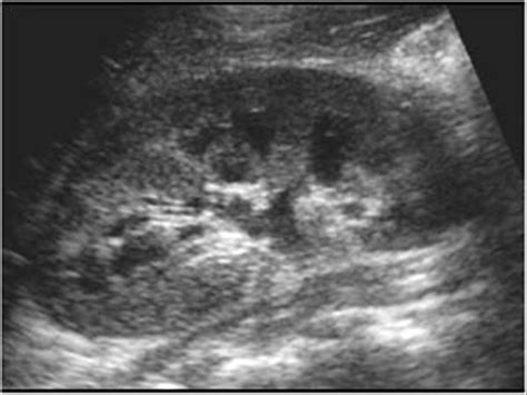 Normal Kidney Ultrasound