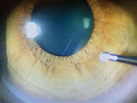 Corneal Rust Ring