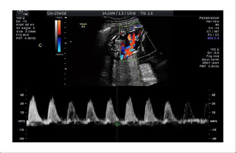 Umbilical artery Doppler ultrasound at 23w5d revealing reversed... | Download Scientific Diagram