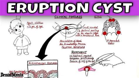 Eruption Cyst Wisdom Teeth