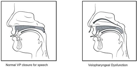 Treatment of velopharyngeal insufficiency - MEDizzy