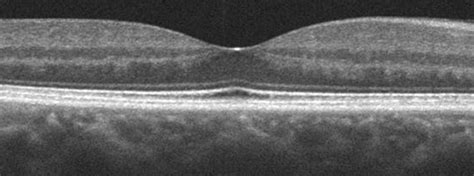 Retina Louisville | Macular Pucker Louisville | Bennett & Bloom