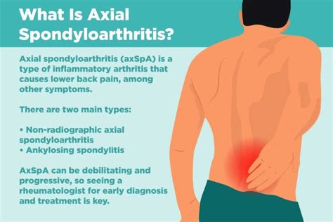 O Que É Espondiloartrite Axial? Sintomas, Causas, Diagnóstico | Société ...