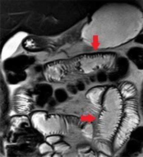 Small bowel involvement in systemic sclerosis. Coronal T2-weighted... | Download Scientific Diagram