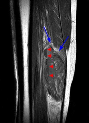 Venous Malformations | Radsource