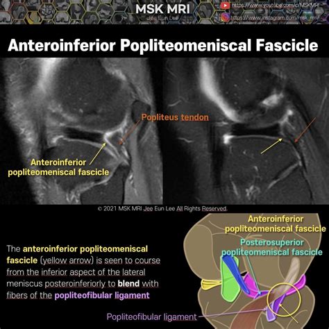 [Anatomy_18] Anteroinferior popliteomeniscal fascicle 01