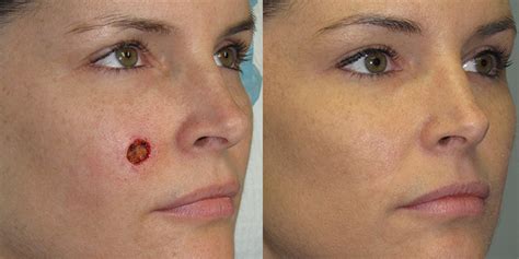 Cheek Reconstruction Gallery | Skin Cancer And Reconstructive Surgery ...