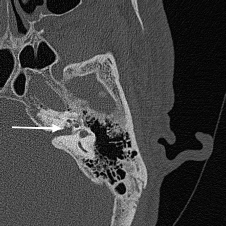 Internal auditory canal mri anatomy - gulflog