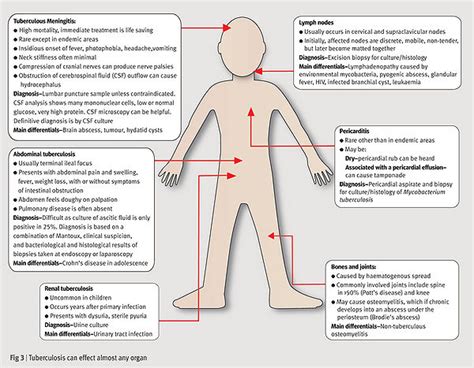 Tuberculosis in Children in Developing Countries - microbewiki