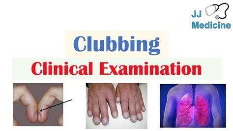 Clubbing (Fingers & Toes) | Causes, Schamroth’s Sign, Associated ...