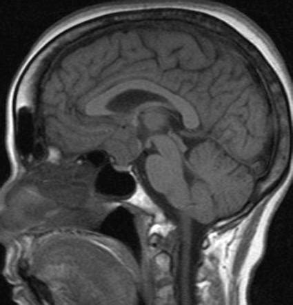 Planum sphenoidale meningioma | Radiology Case | Radiopaedia.org