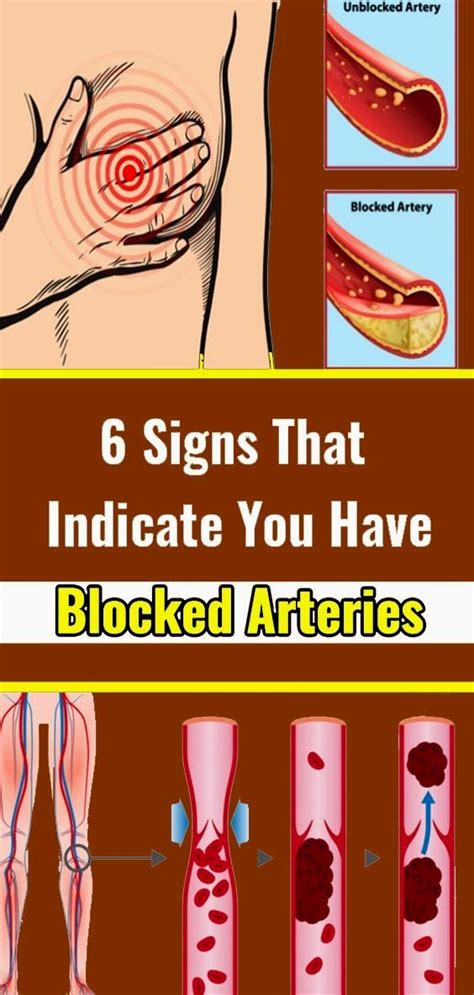 6 Signs That Indicate You Have Blocked Arteries | V-Remedies