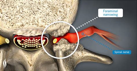 PINCHED NERVE IN MY SPINE | Microspine PLC