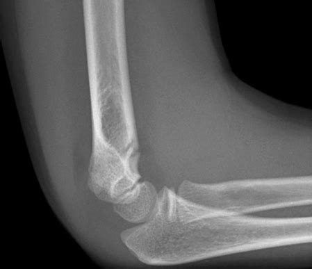 Supracondylar Fractures - JUNIORBONES