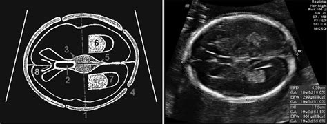 A pictorial guide for the second trimester ultrasound - Bethune - 2013 - Australasian Journal of ...