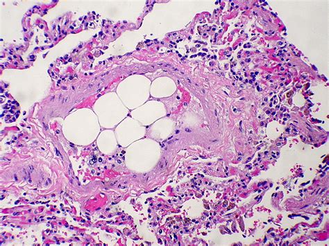 Embolus vs. thrombus | Pathology Student