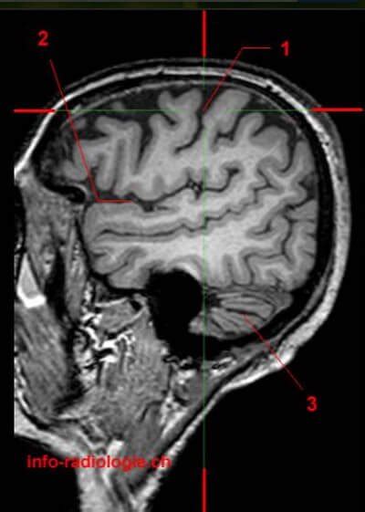 Central Sulcus - Definition, Location (MRI) and Function