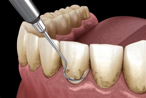 Everything You Need to Know About Scaling and Polishing Teeth