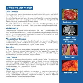 Liver Sciences | Hepatology | Liver Transplant | AIG Hospitals | PDF