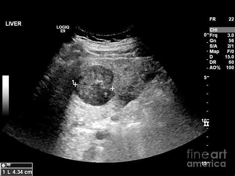 liver pathology ultrasound - Google Search | Ultrasound, Pathology, Liver