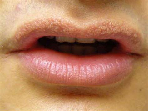 Rash On Lips Pictures - PictureMeta