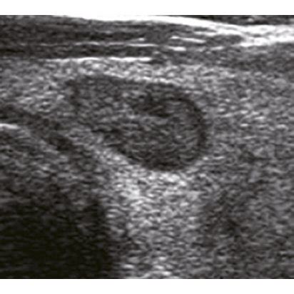 Adjustment of C-TIRADS classification of thyroid nodule with... | Download Scientific Diagram