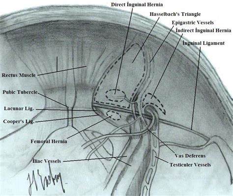 Laparoscopic Inguinal Hernia Surgery Anatomy