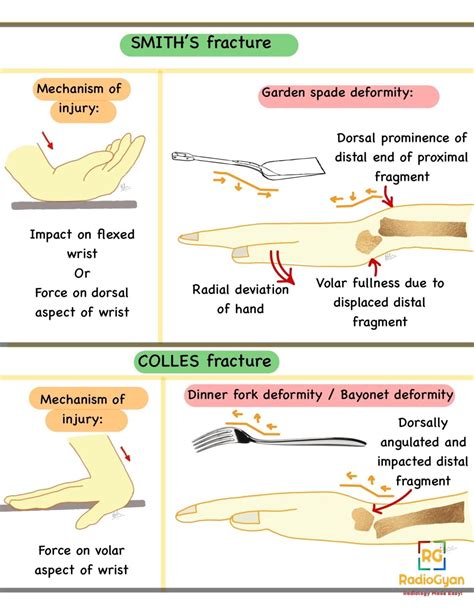 Smith Fracture - Distal Radial Fracture | Radiology Case | - RadioGyan