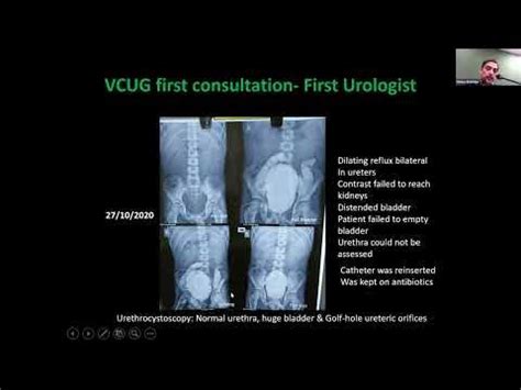 Underactive Bladder Etiology, Diagnosis, treatment by Anil Takvani - YouTube